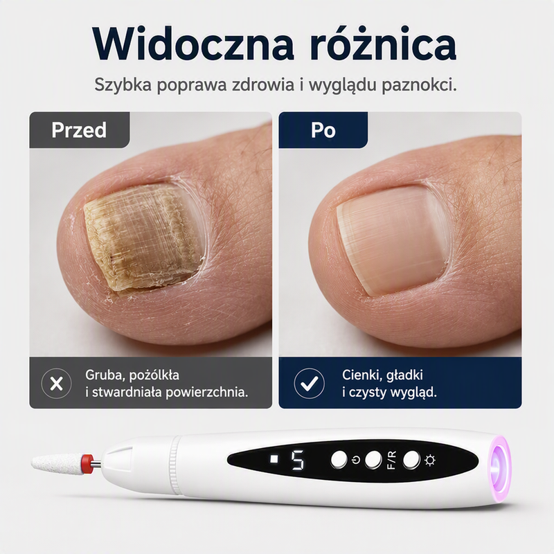 Męczy Cię ręczne opiłowywanie grubych paznokci, które zajmuje wieczność? – elektryczna pilniczka do paznokci z wysokim momentem obrotowym – wypróbuj szybkie i równomierne opiłowanie bez wysiłku. Na pobranie! 💅